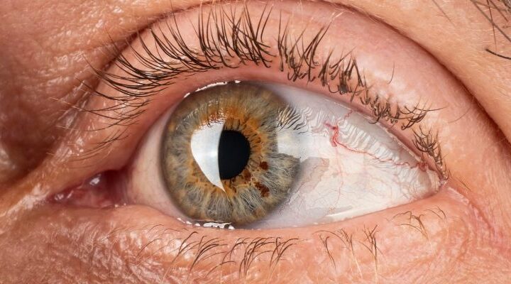 Dubai Vision Care: Insight on Eye Conditions and Treatments