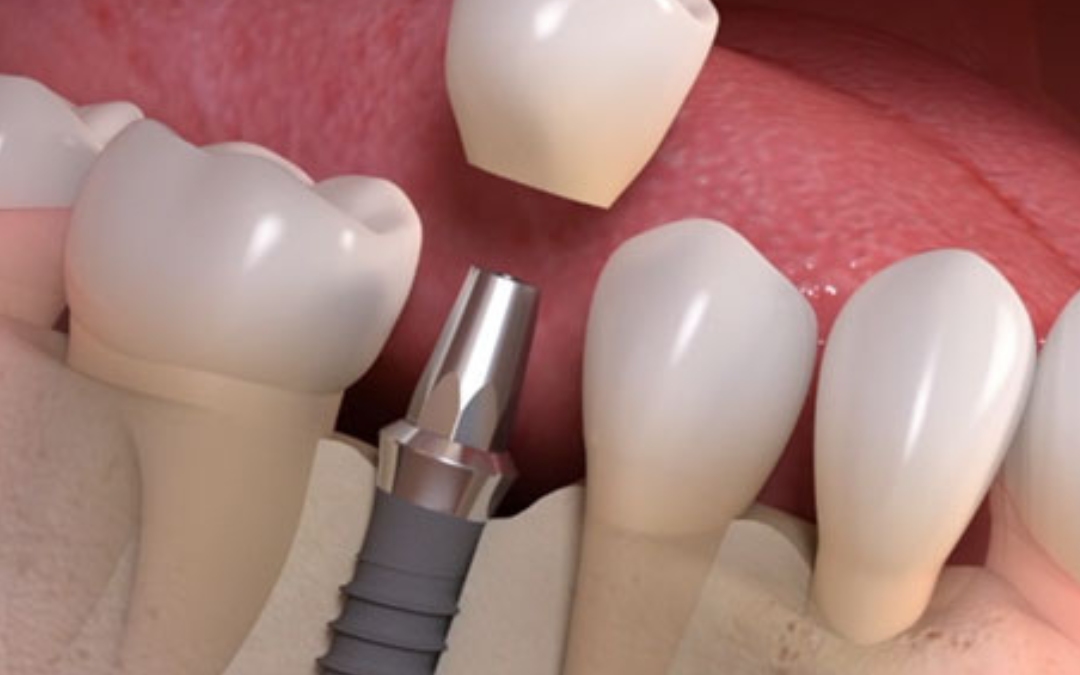 Average Dental Implants Cost in Dubai and Price Range
