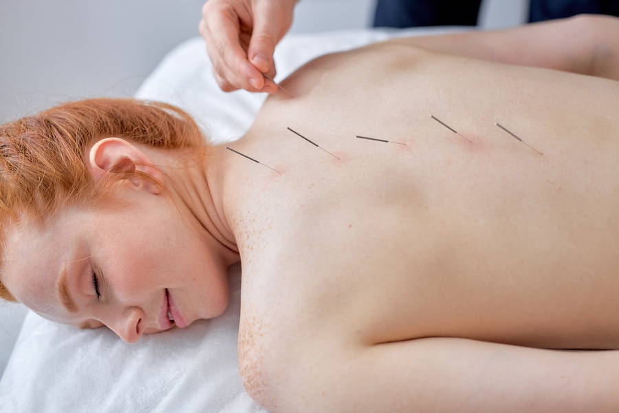 What Is Acupuncture and How It Supports Natural Healing?