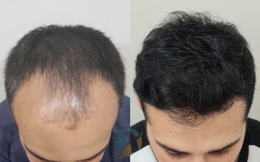 hair transplant i islamabad