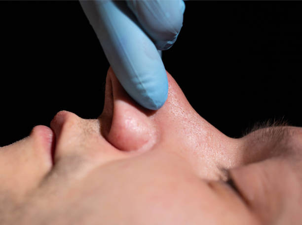 Nosebleeds (Epistaxis): Causes, Treatment & Prevention