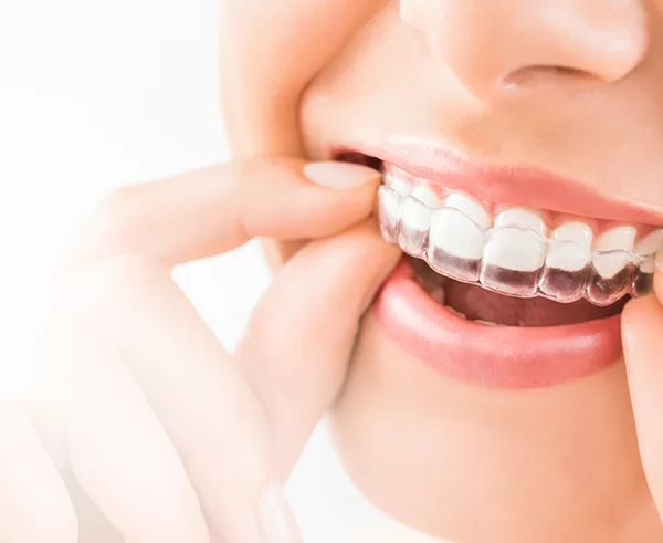 Invisalign Consultation
