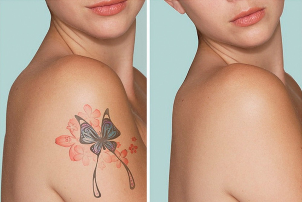 Tattoo Removal 1 1