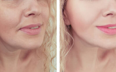 Refining Neck Elegance with Double Chin Removal in Abu Dhabi