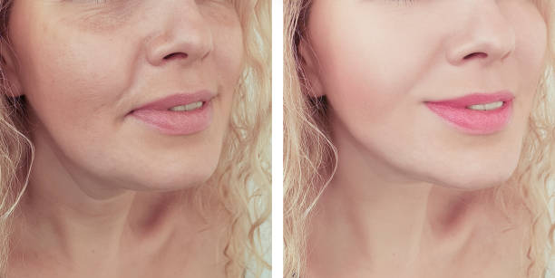 Refining Neck Elegance with Double Chin Removal in Abu Dhabi
