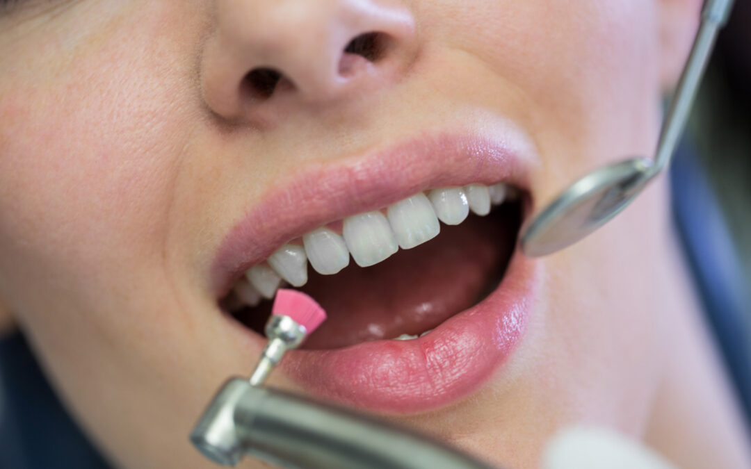 Permanent Platinum Teeth