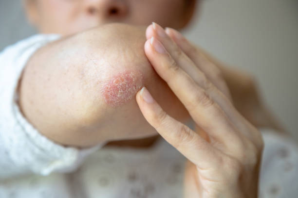 Can Eczema Treatment Control Skin Flaking