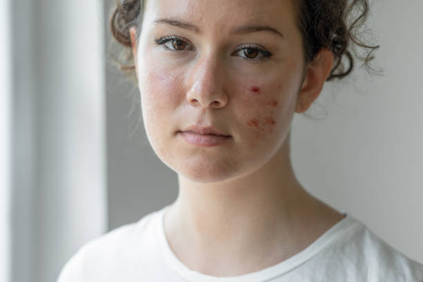 Can Laser Acne Scar Treatment Reduce Large Pores