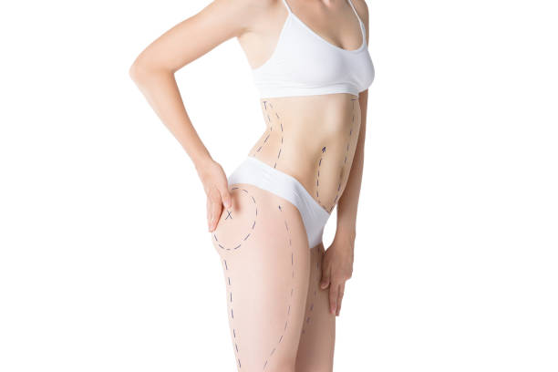 Can Liposuction Improve Body Symmetry