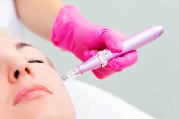 Can Microneedling Treat Rough Skin Texture Issues