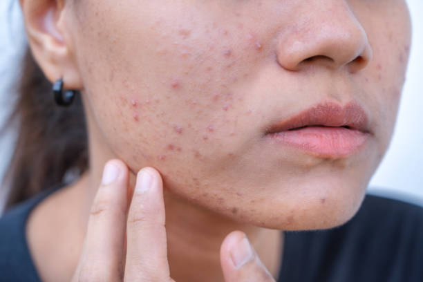 Does Acne Treatment help reduce acne sensitivity