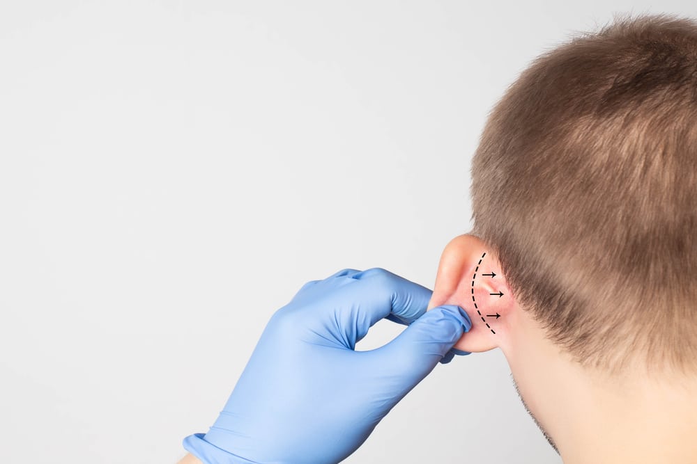 Ear Reshaping | Otoplasty in Abu Dhabi