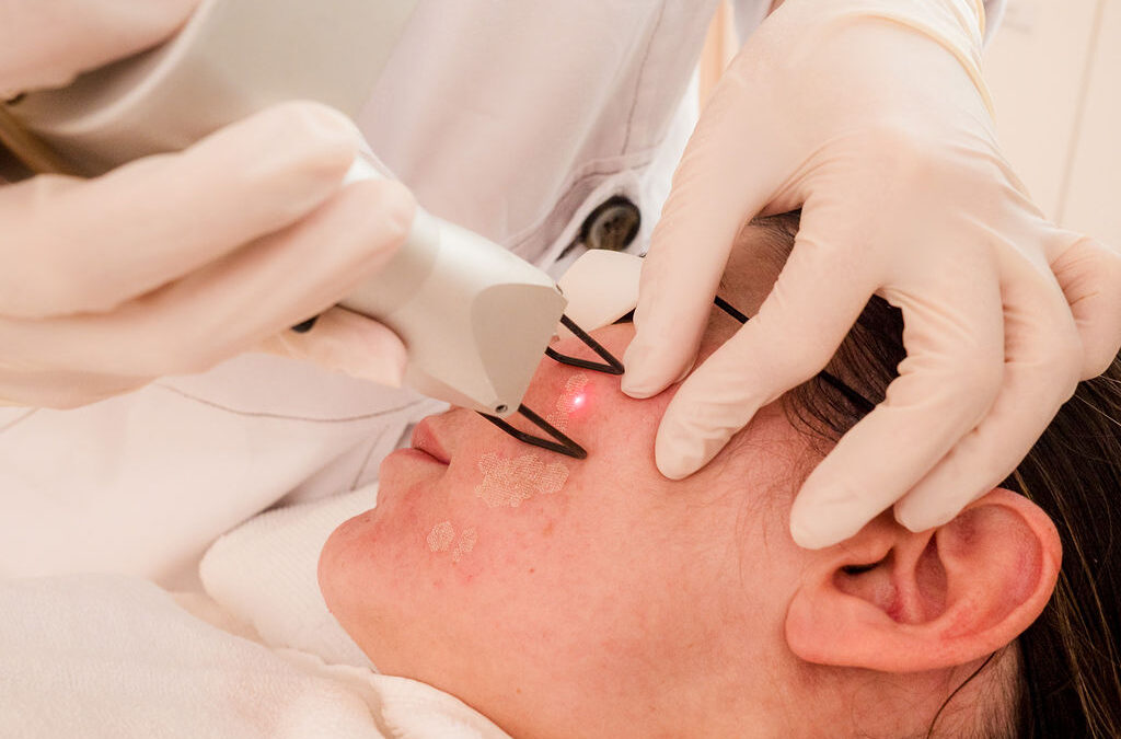 Fractional CO2 laser treatment Abu Dhabi