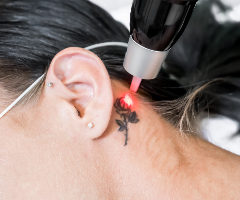 How Laser Tattoo Removal Clears Skin Fast