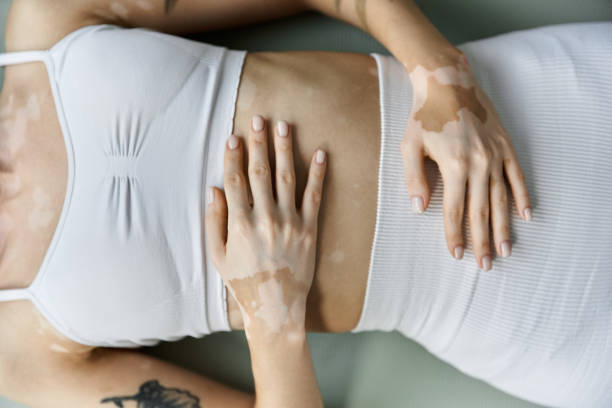 How does skin type affect vitiligo treatment plans