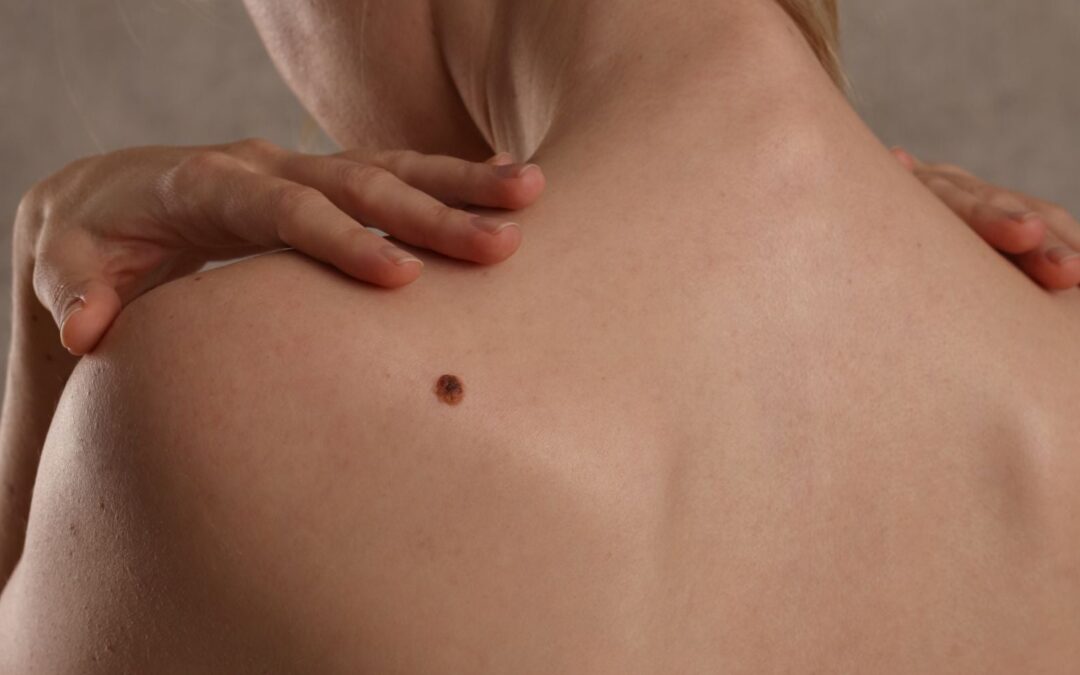 How to Prepare for Skin Tag Removal Procedure