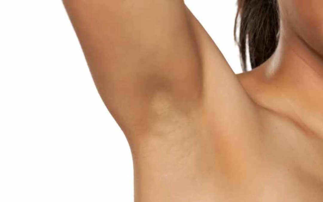 Is Underarms Whitening Treatment Better Than Home Remedies?