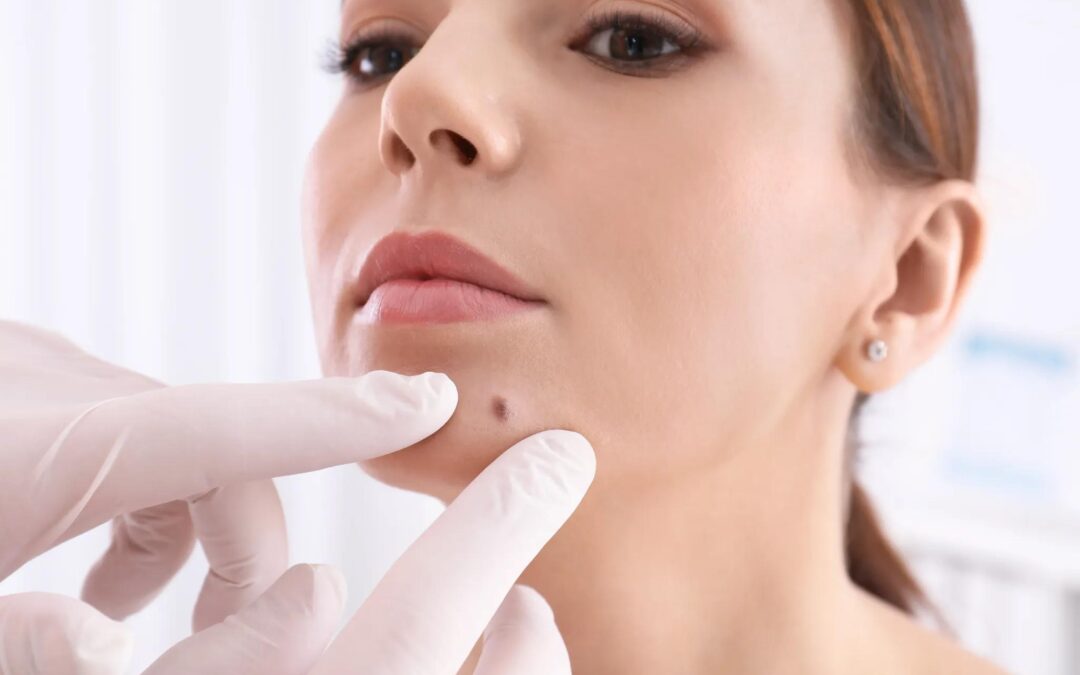 What Is the Best Method for Mole Removal