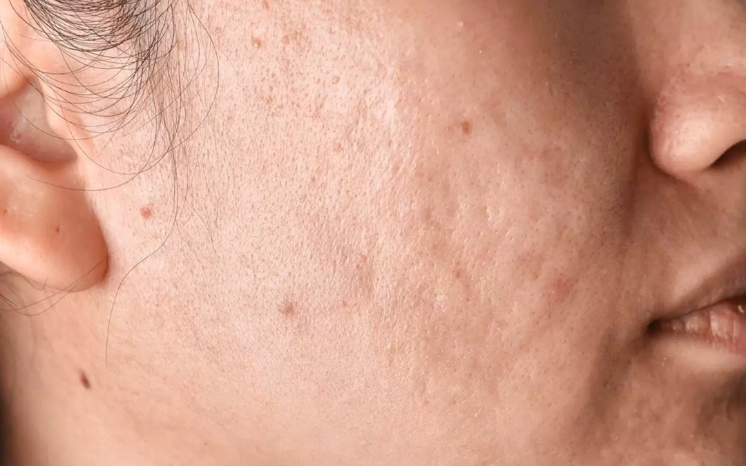 What Laser Acne Scar Treatment Experts Recommend