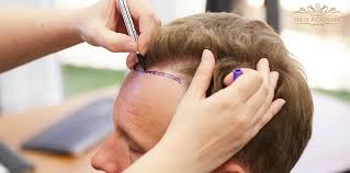 What to Expect After DHI Direct Hair Implant