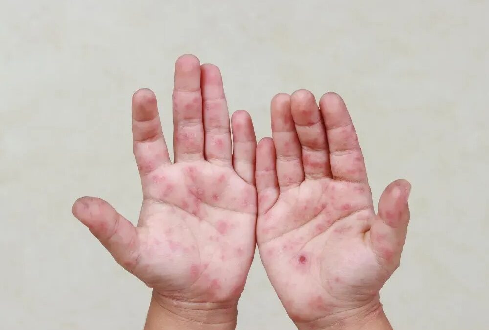 كيف يُخفف علاج الأمراض الجلدية الاحمرار بسرعة؟