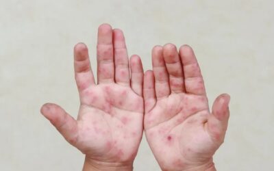 كيف يُخفف علاج الأمراض الجلدية الاحمرار بسرعة؟