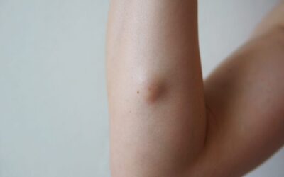 هل علاج الأورام الشحمية مؤلم أم آمن تمامًا؟
