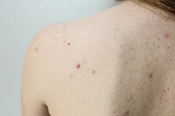 Can Skin Tag Removal Deliver Instant Skin Results