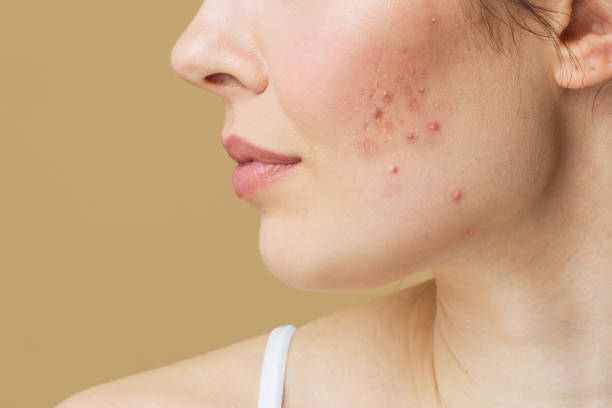 Does Laser Acne Scar Treatment Leave Redness