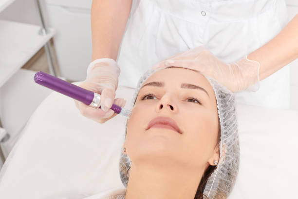 Does Microneedling Help With Dark Spot Removal