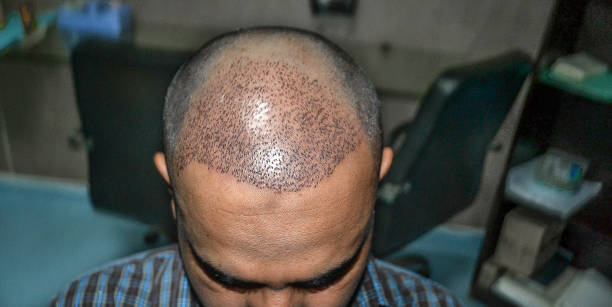 تكلفة زراعة الشعر في دبي: دليل شامل لأسعار عام 2026