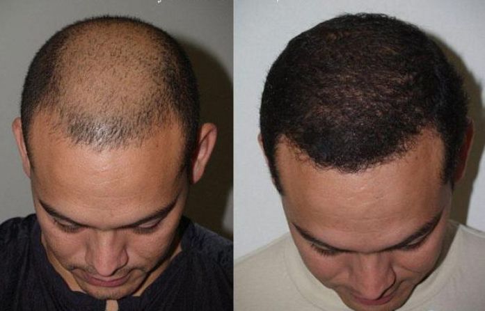 توفير ذكي: كيف تحصل على أفضل قيمة مقابل تكلفة زراعة الشعر في دبي؟
