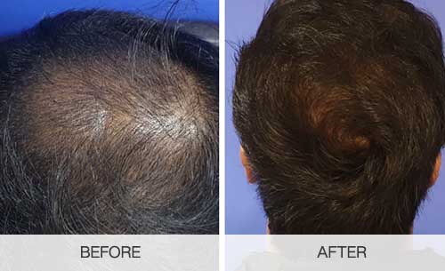 استثمار العمر: هل تكلفة زراعة الشعر في دبي تستحق العناء؟
