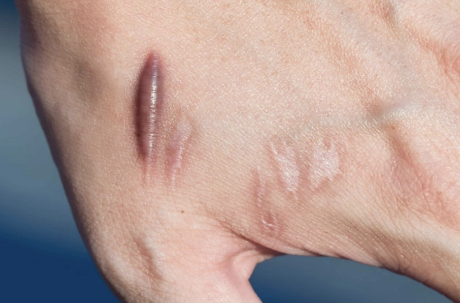 How Keloid Treatment Restores Smooth Skin