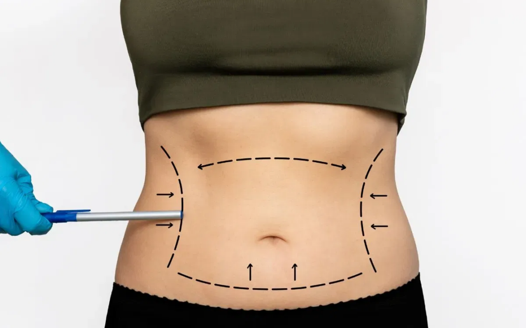How Tummy Tuck Removes Excess Belly Fat