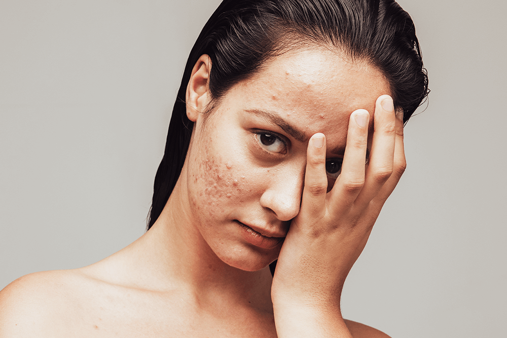 Is Acne Treatment a Permanent Skin Solution