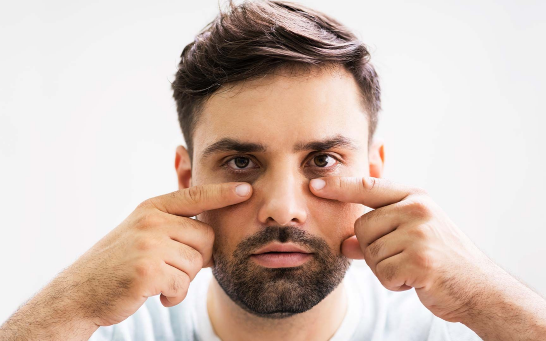 Is Dark Circles Treatment Effective for Men