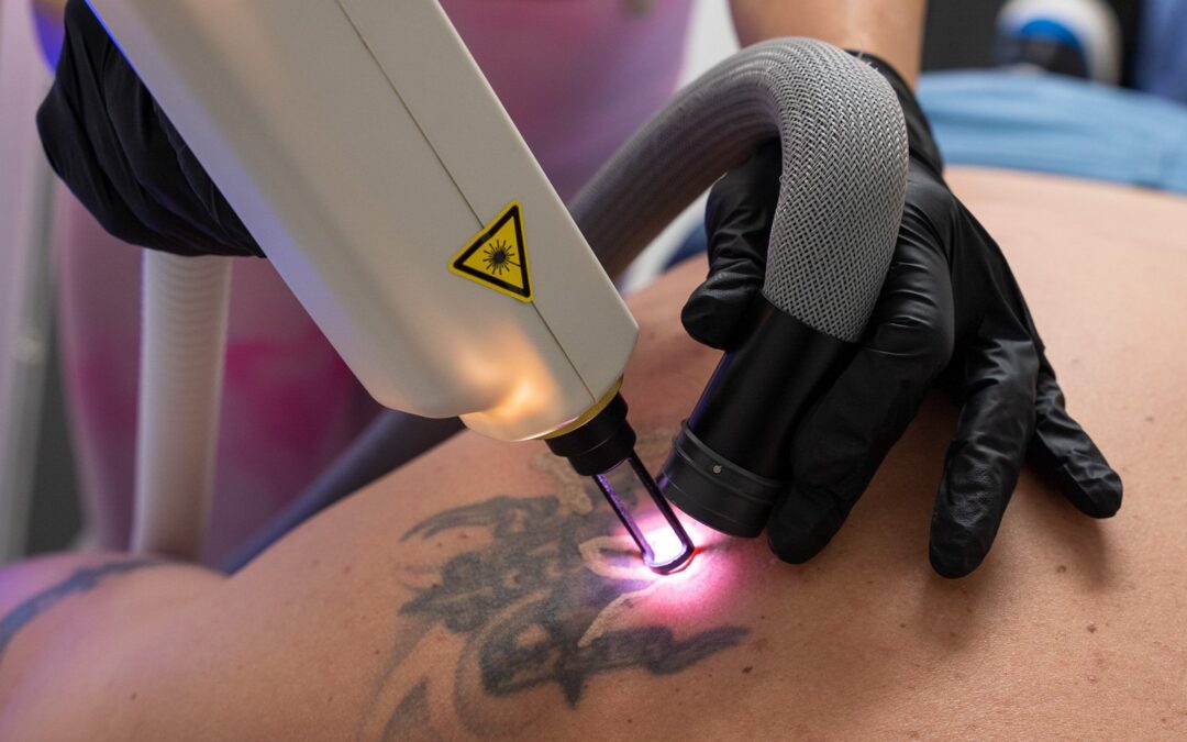 Is Picosure Tattoo Removal Good for All Skin