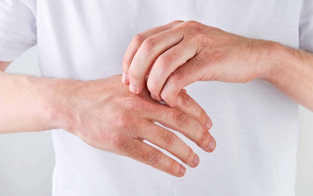Is Skin Diseases Treatment Right for You