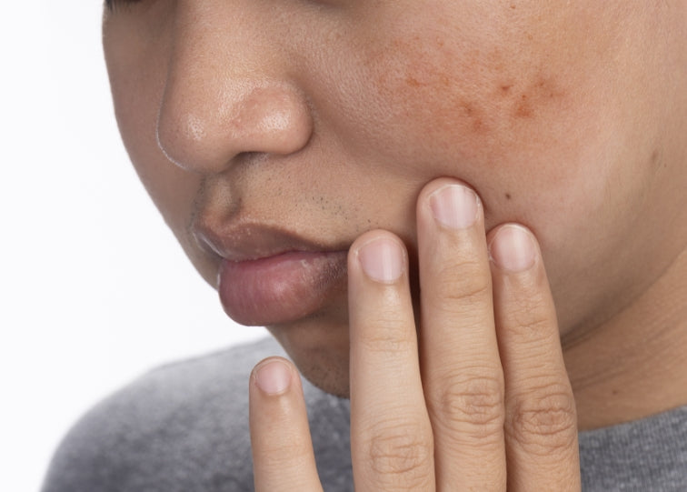 What Are the Benefits of Pigmentation Treatment