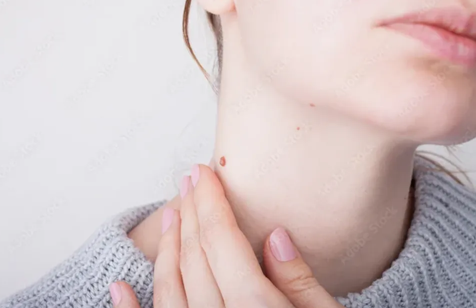 What Happens During Warts Removal Treatment