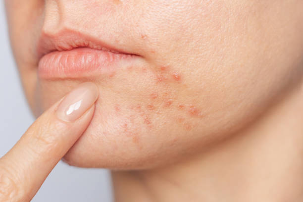Can Acne Treatment Remove Deep Acne Marks