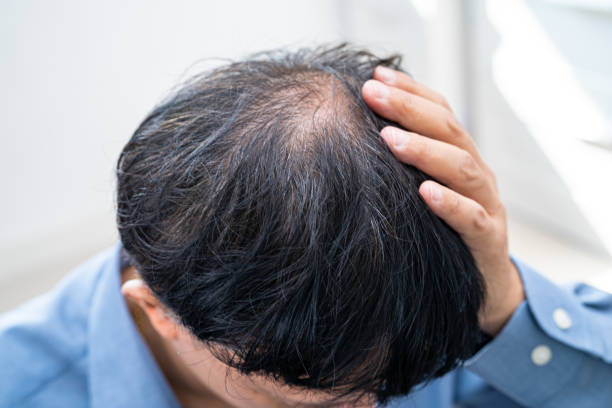 Can GFC Treatment for Hair Reverse Early Hair Loss