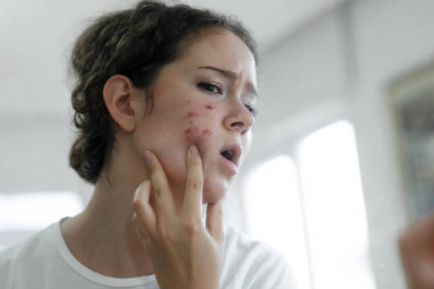 Can Laser Acne Scar Treatment Boost Skin Confidence