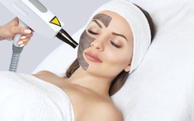 Can Laser Carbon Peeling Remove Dead Skin?