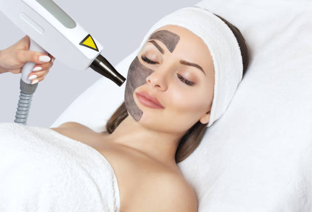 Can Laser Carbon Peeling Remove Dead Skin?