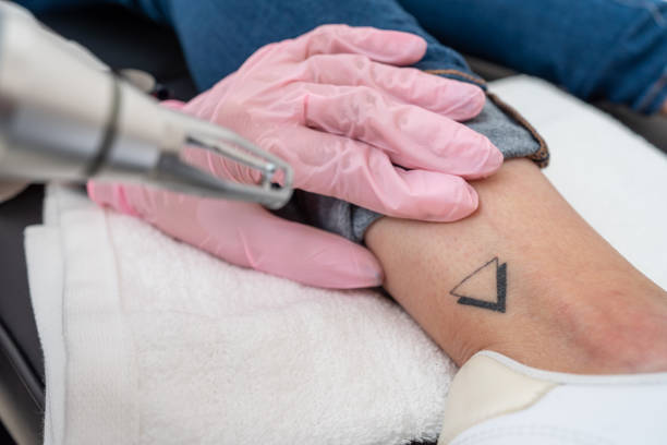 Can Laser Tattoo Removal Cause Skin Darkening?
