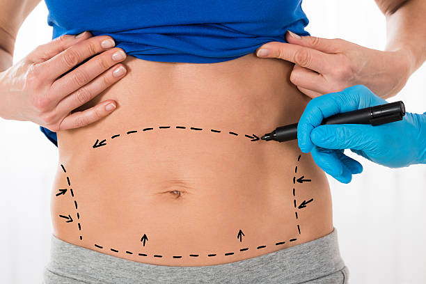 Can Tummy Tuck Help Restore a Flatter Stomach