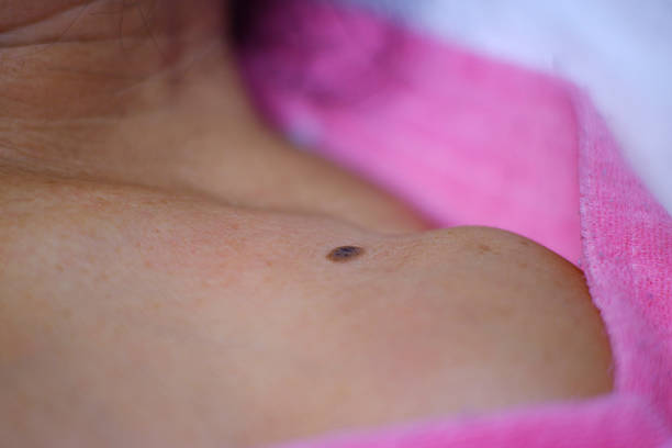 Can Warts Removal Treatment Remove Deep Warts?