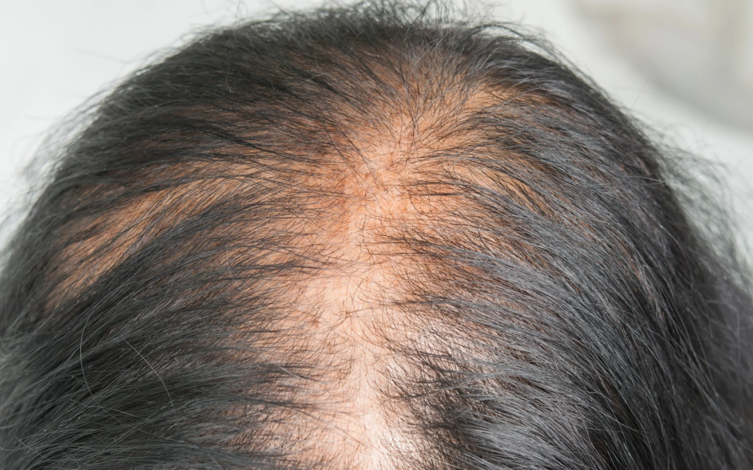 Does Hair Loss Treatment Help Regrow Lost Hair?